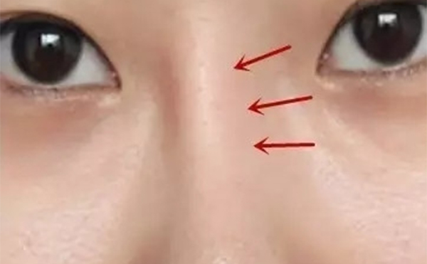 假體隆鼻時(shí)間長了出現(xiàn)假體移位等并發(fā)癥后該怎么辦？