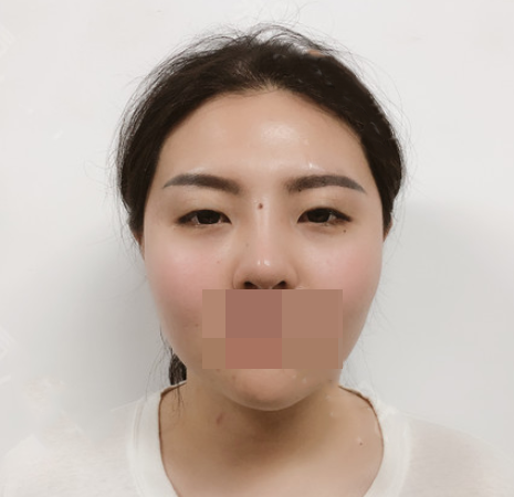 雙眼皮手術(shù)恢復(fù)效果