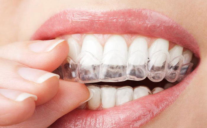 手術(shù)矯正牙齒費用大概多少？手術(shù)矯正牙齒怎么矯正？