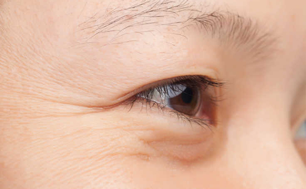 眼部皺紋的形成原因是什么?眼部除皺有什么方法?