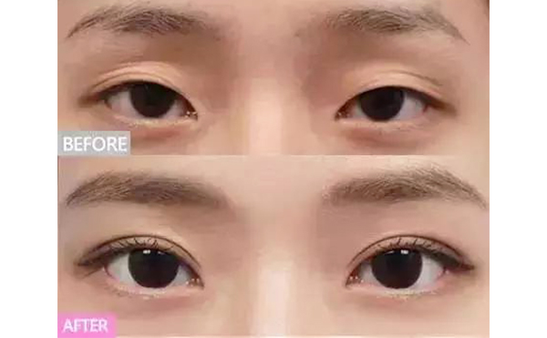 上眼皮凹陷怎么恢復飽滿?能維持多久?