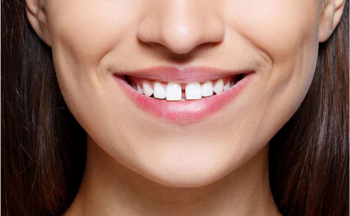 牙縫大可以矯正嗎？