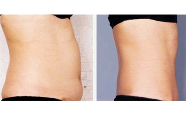 腰腹吸脂安全性高嗎？