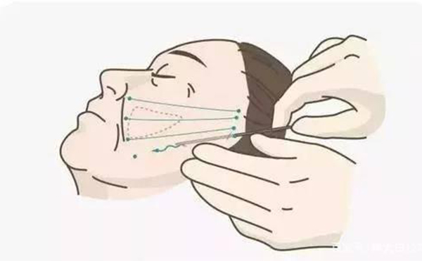 線(xiàn)雕提升好嗎？