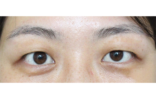 腫眼泡做雙眼皮一定要抽脂嗎?抽脂眼部松弛怎么辦?