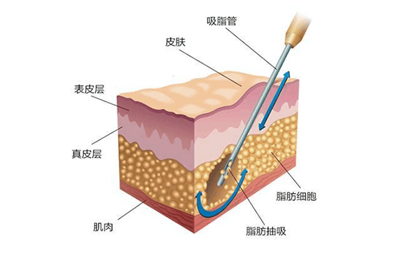 背部吸脂術(shù)后會(huì)留疤嗎?會(huì)不會(huì)反彈?