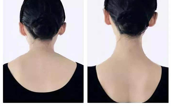 瘦肩針是用什么打的？