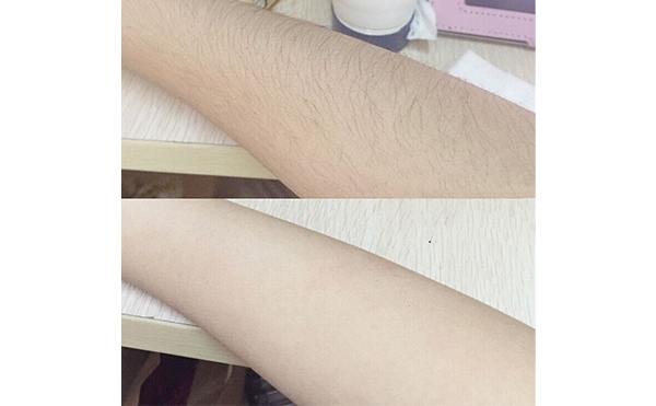 光子手臂脫毛效果怎么樣？