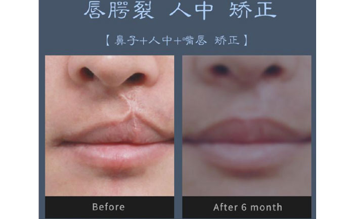 唇裂修復(fù)術(shù)需要多少錢？