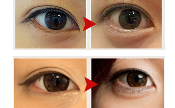 玻尿酸豐臥蠶和自體真皮豐臥蠶有什么區(qū)別?哪個(gè)好?