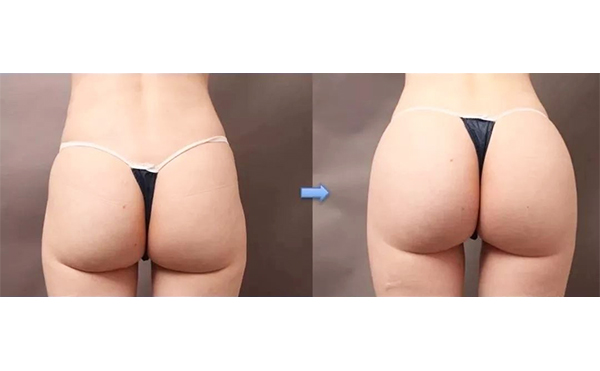 假體豐臀要注意什么?術(shù)后會不會移位?