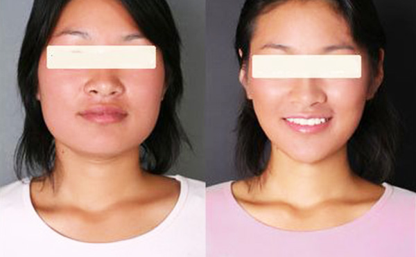 超聲波面部吸脂的原理是什么？