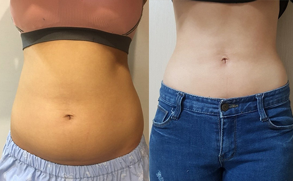 腰腹吸脂的效果好嗎？