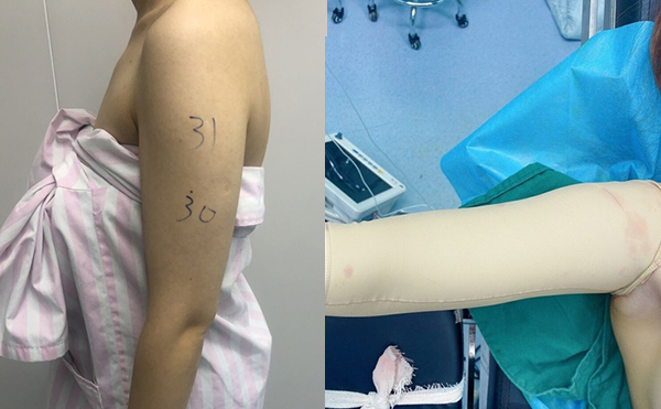 手臂吸脂安全嗎？