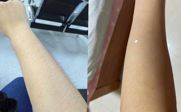 激光手臂脫毛價格貴不貴？