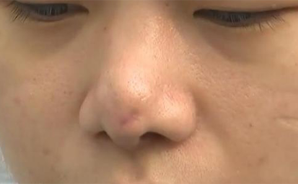 如果更換隆鼻假體，當(dāng)天可以直接換嗎?