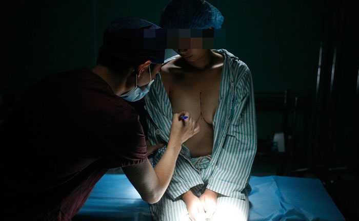 目前哪種隆胸最安全？假體隆胸哪種植入方法最好？