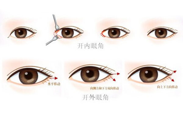 開內(nèi)眼角和外眼角有什么區(qū)別?開內(nèi)眼角需要注意什么?