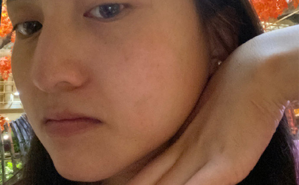 上海首爾麗格樸興植下頜角截骨手術(shù)案例術(shù)后兩個月