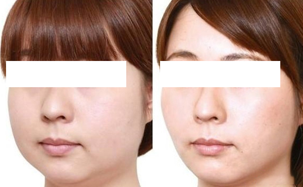 面部吸脂安全嗎？