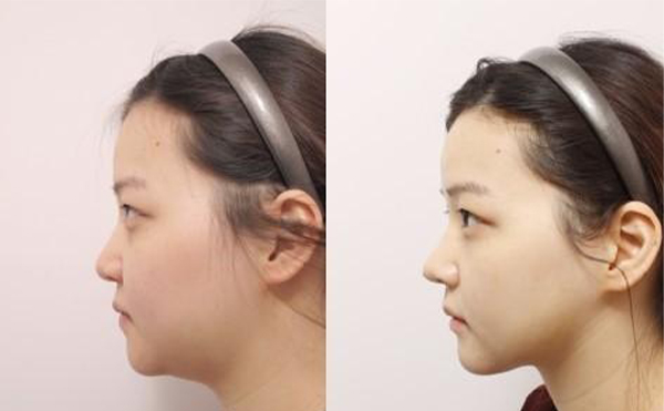 五類建議做下巴整形的下巴，快看看有沒(méi)有你