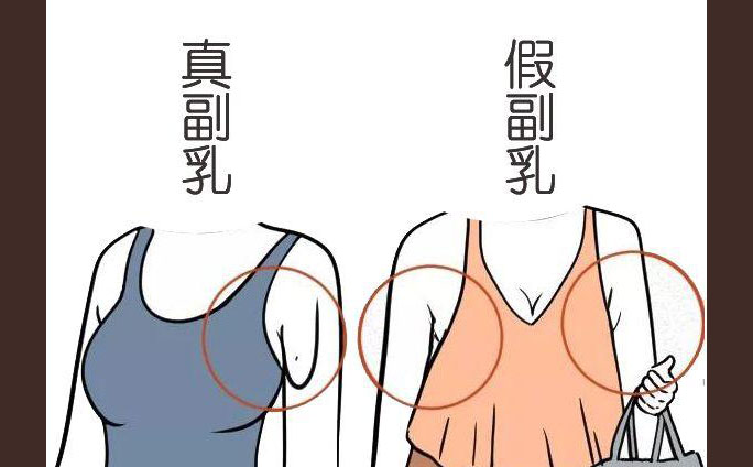 多乳癥是什么癥狀？