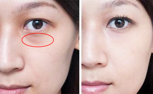 淚溝是怎么形成的?淚溝怎么才能消除?