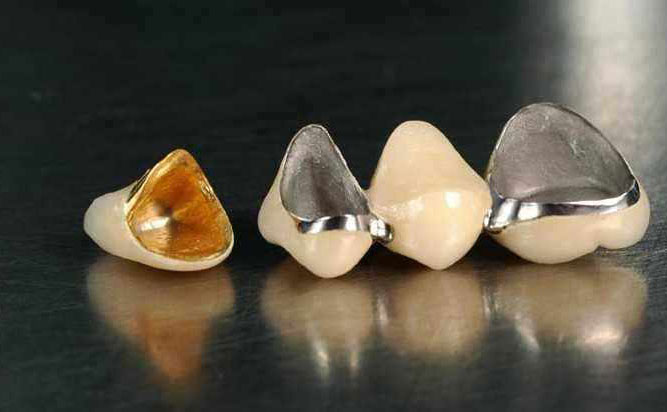 貴金屬烤瓷牙多少錢一顆？