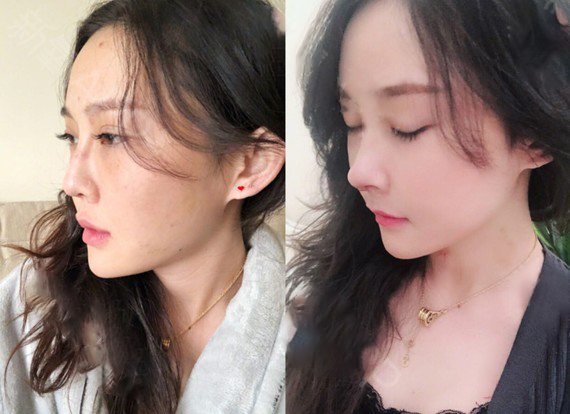 肋骨隆鼻手術(shù)效果圖2