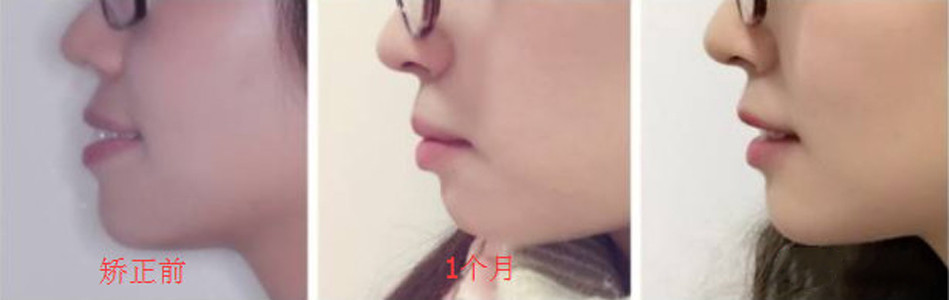 牙齒矯正前后效果對比圖