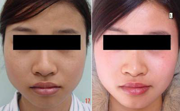 激光美白是什么原理？