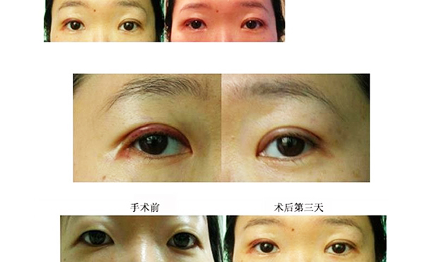開(kāi)外眼角和眼瞼下至的區(qū)別是什么?多久恢復(fù)好?