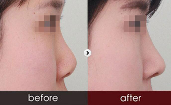 硅膠隆鼻一般需要多少錢呢？