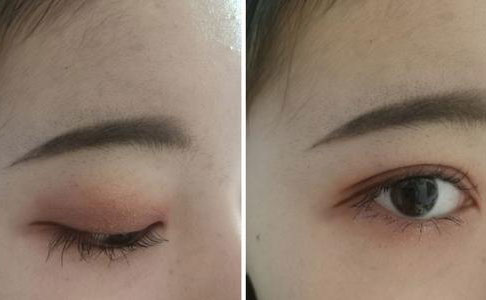 割雙眼皮的危害是什么？