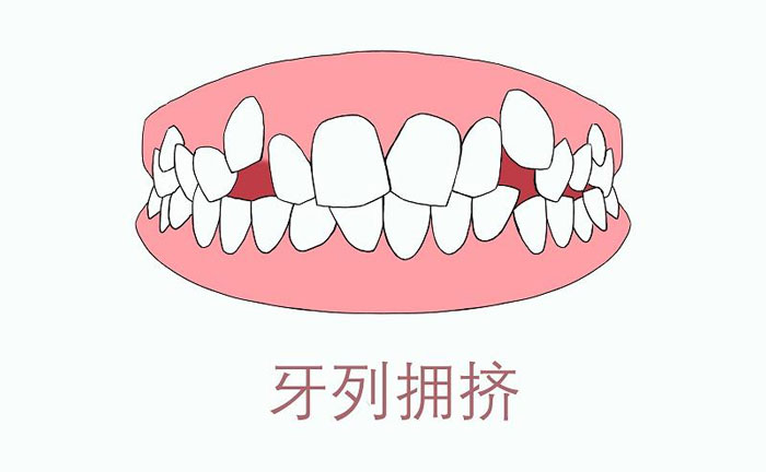 矯正牙齒擁擠度怎么算？