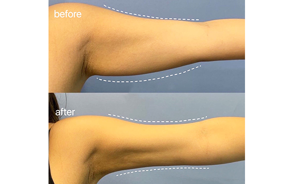 蝴蝶臂是什么原因造成的?怎么減有效?