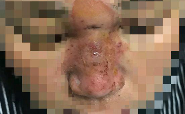 絕對不能用于注射隆鼻的材料