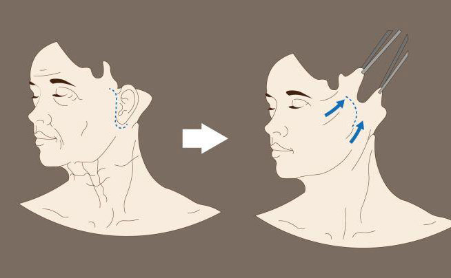 電波拉皮一次大概多少錢？