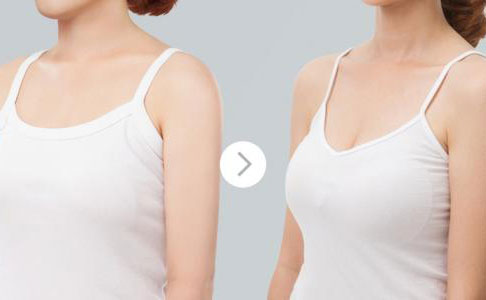 假體隆胸的費用是多少？