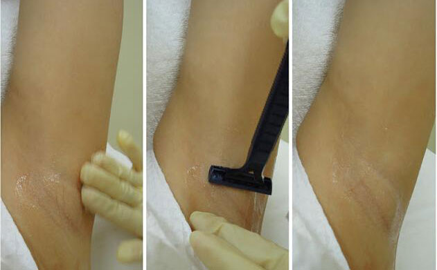 激光脫腋毛安全嗎？