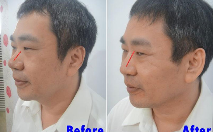 男性隆鼻子大概多少錢？