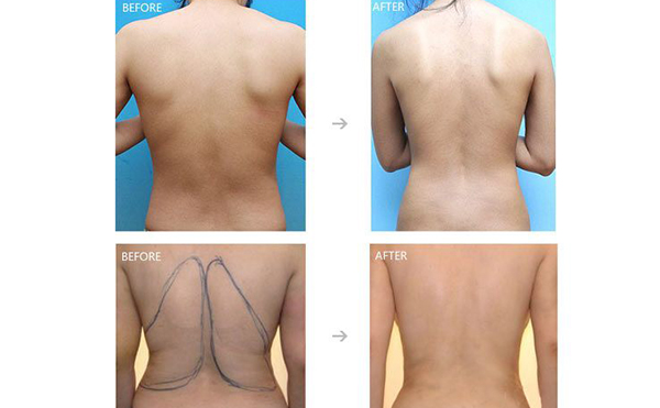 背部吸脂能維持多久？