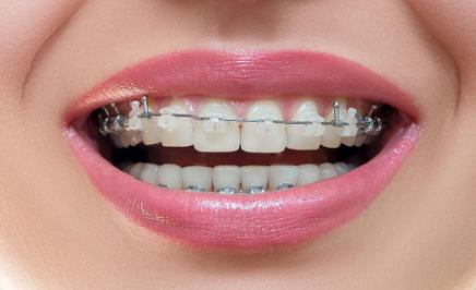 隱形牙套多久換一副？