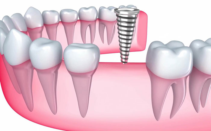 牙齒種植大概費用是多少？牙齒種植多少錢一顆