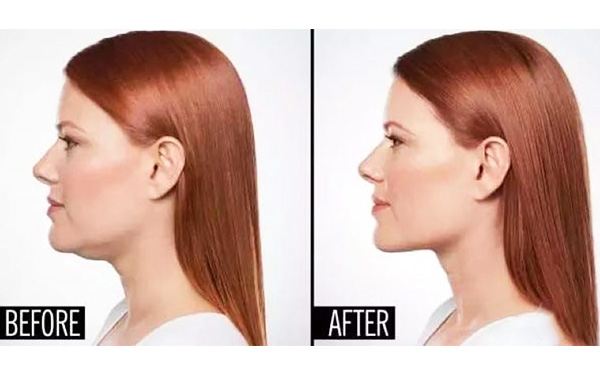 超聲波面部吸脂的過程是什么？