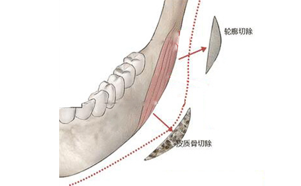 下頜角手術(shù)并發(fā)癥