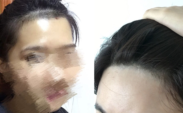 冰點(diǎn)面部脫毛有沒有疼痛感？