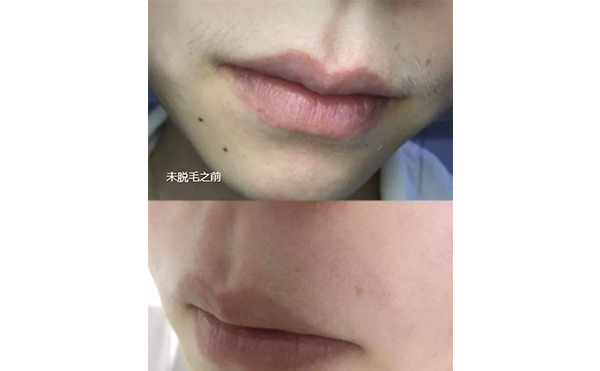 脫毛需要多久恢復?面部脫毛間隔多久做一次?