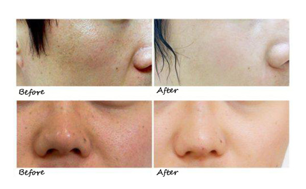 水光針的效果怎么樣？