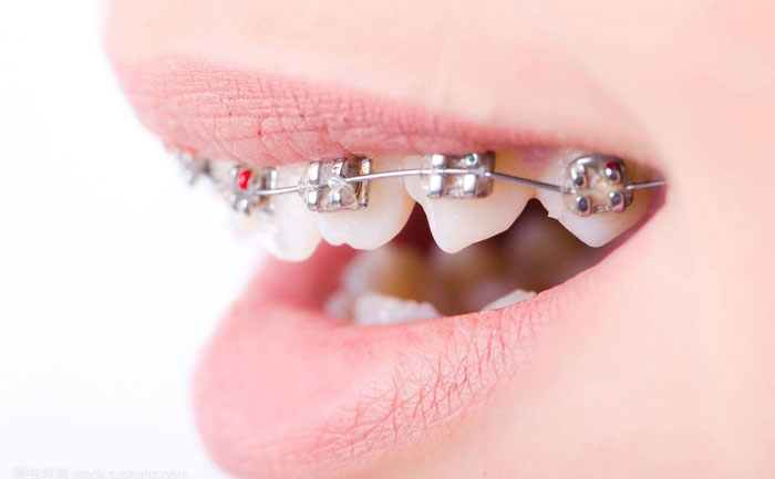 口腔正畸的最佳治療方法？口腔正畸的最佳年齡是多少？